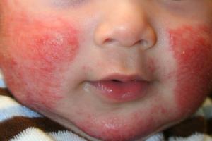 Traitement des allergies chez l'adulte